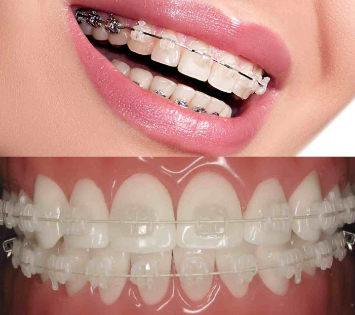 Görünmez Ortodonti Devrimi: Şeffaf Plaklar (Aligner) mı, Yoksa Lingual Diş Telleri mi? 2026 Güncel Fiyat ve Karar Verme Kılavuzu