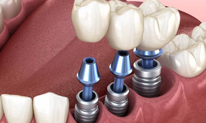İmplant Tedavisi Sonrası Bakım ve İyileşme Rehberi: Tedavinin Ömrünü Uzatmak İçin Ağız Hijyeni ve Beslenme Stratejileri