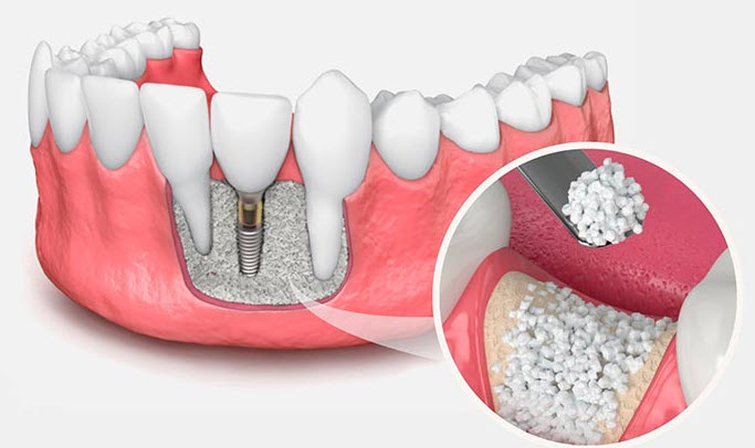 Kemik Grefti (Kemik Tozu Ekimi) ve İmplant İlişkisi: Çene Kemiği Yetersiz Olan Hastalar İçin İmplant Tedavisi Mümkün mü?