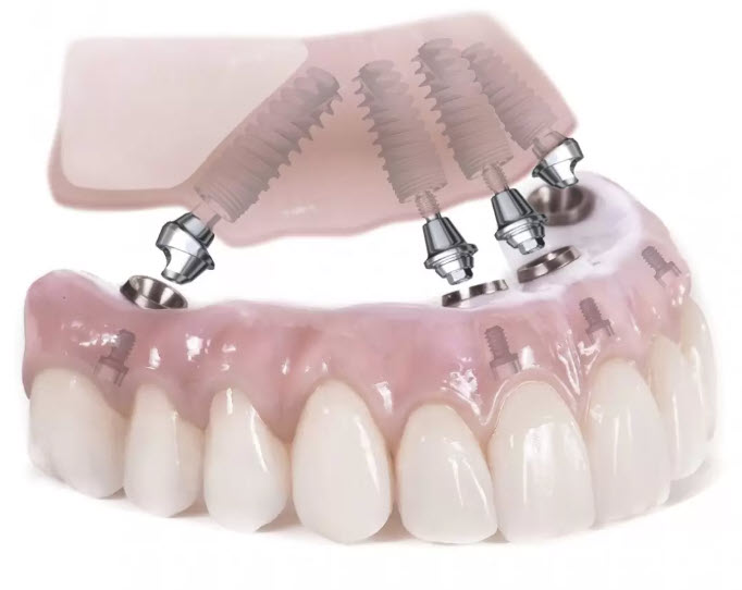 All on 4 ve All on 6 İmplant Teknikleri: Tam Dişsizlik Durumunda Sabit Protezlere Giden En Hızlı ve Etkili Yol